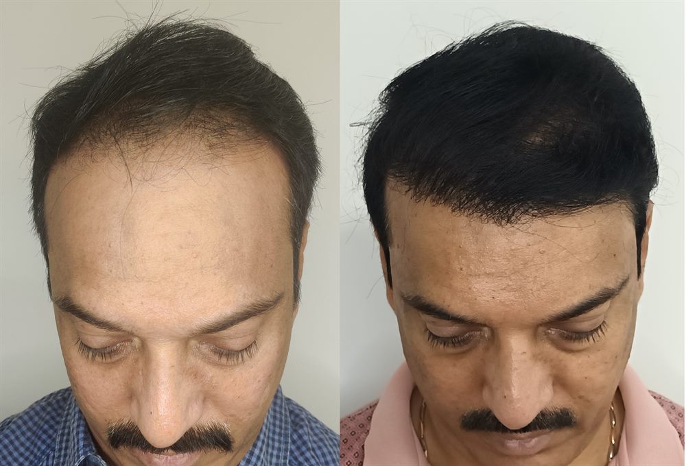 Crown and scalp hair restoration result
