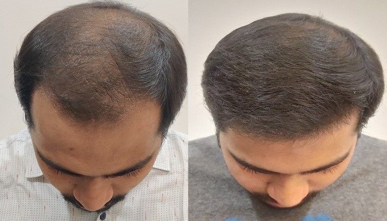 Hair transplant result clinical photo