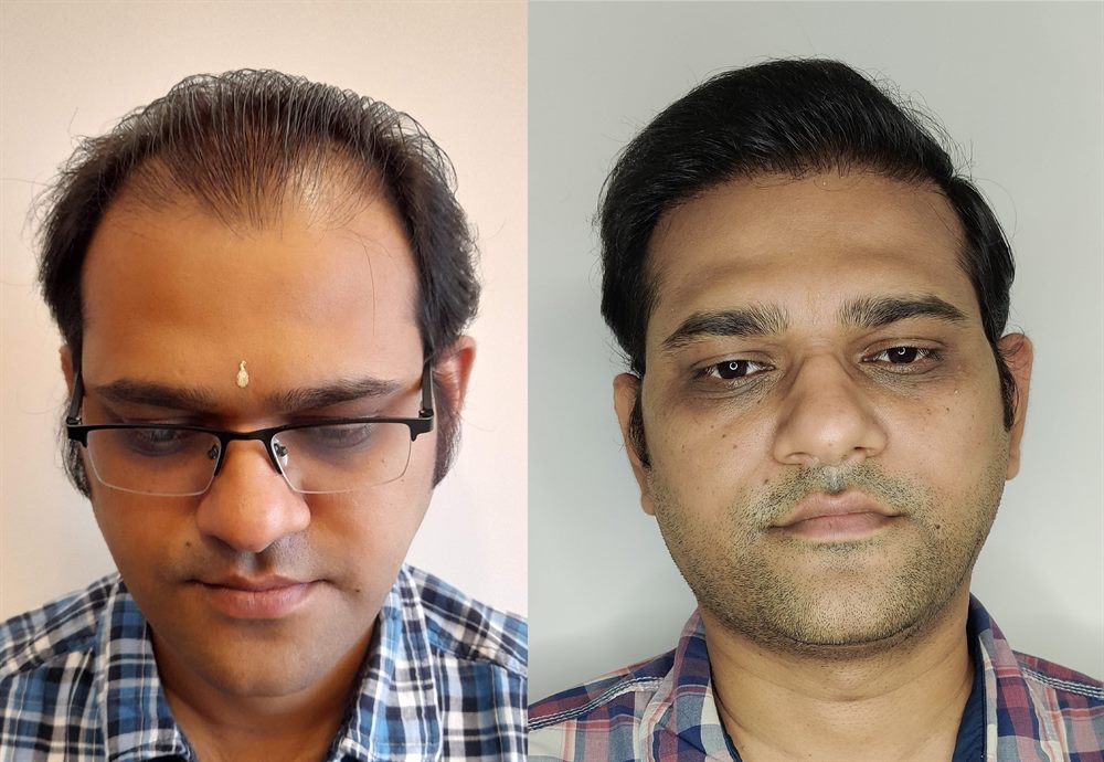 Hair transplant patient result showing improved density