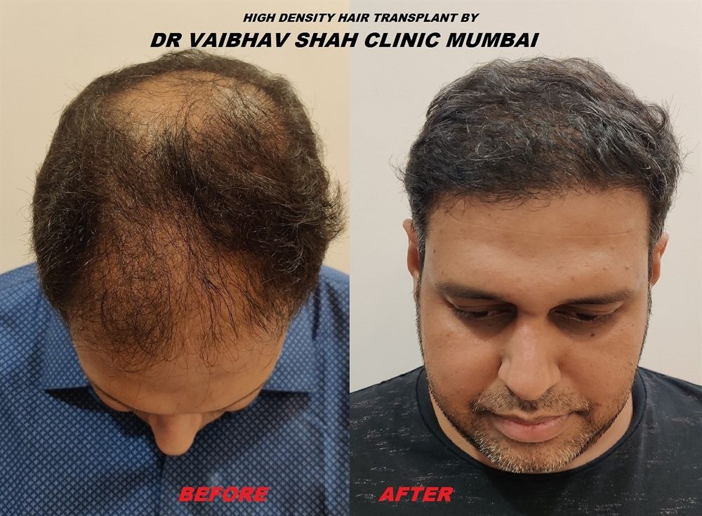 Advanced hair transplant patient result
