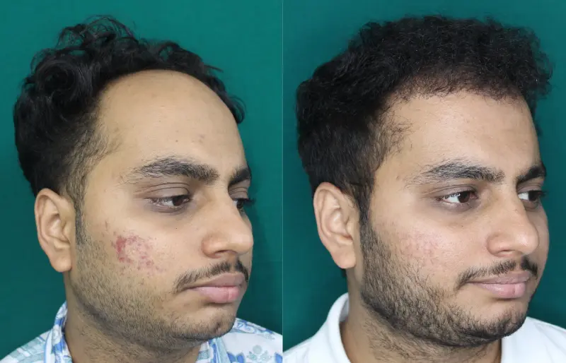 Chaityana Desai hair transplant before and after result 3