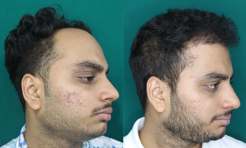 Chaityana Desai hair transplant before and after result 4