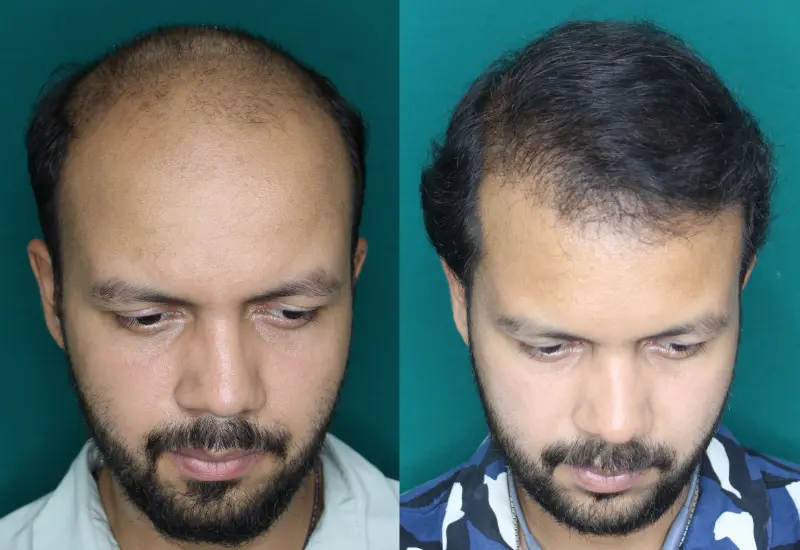 Pt Rushabh Singh hair transplant result