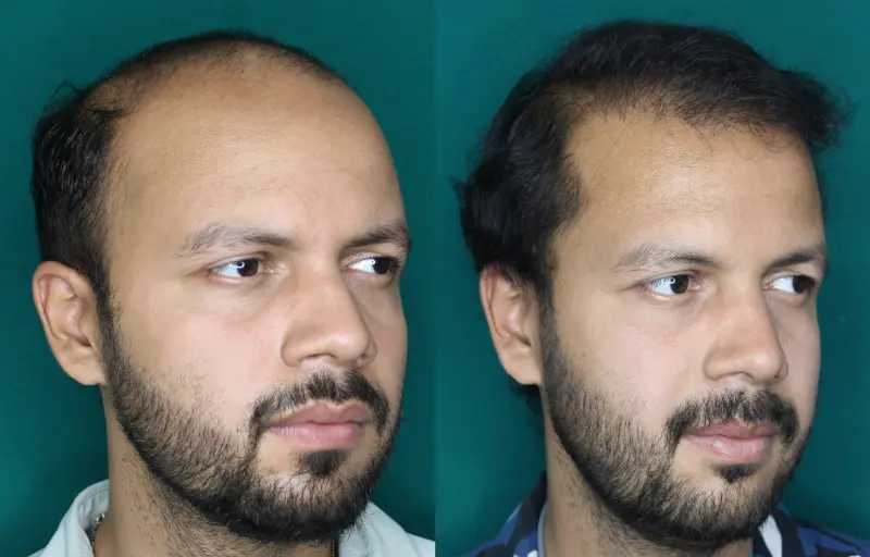 Pt Rushabh Singh hair transplant result 2