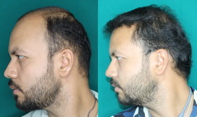Pt Rushabh Singh hair transplant result 5