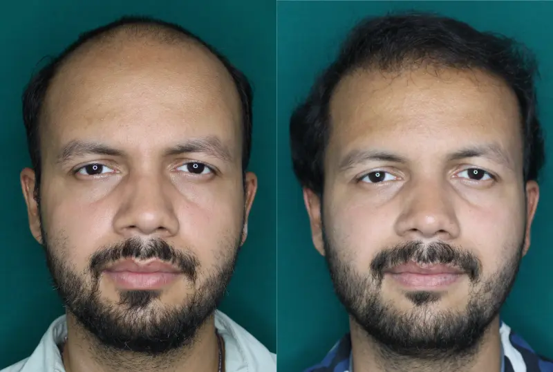 Pt Rushabh Singh hair transplant result 6