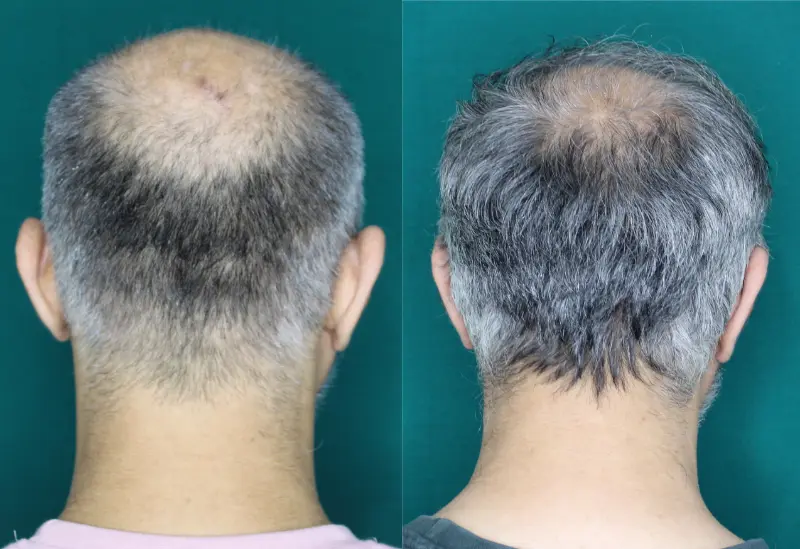 Pt Abhishek hair transplant result