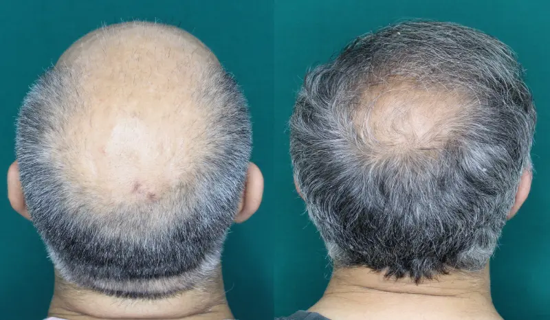 Pt Abhishek hair transplant result 2