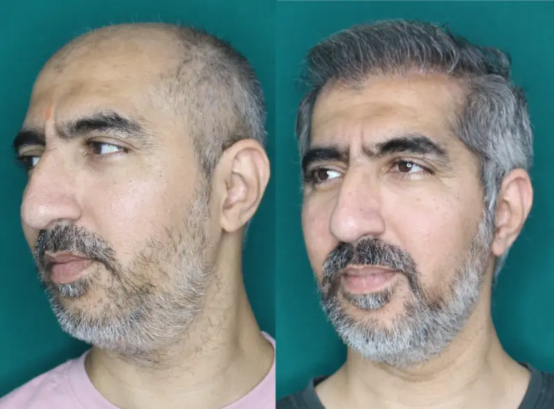 Pt Abhishek hair transplant result 5
