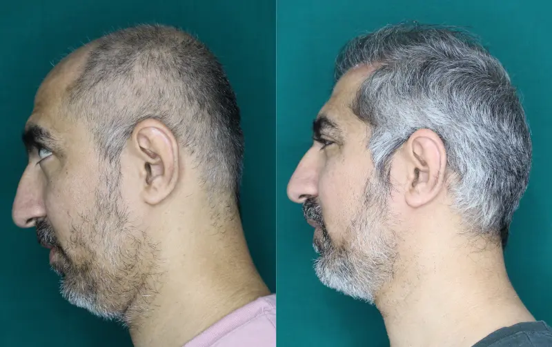 Pt Abhishek hair transplant result 7