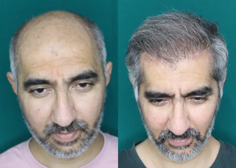 Pt Abhishek hair transplant result 8