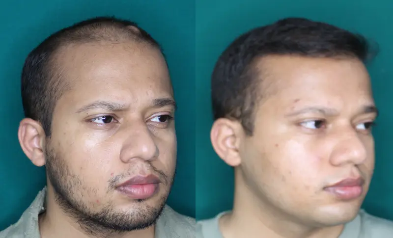 Pt Dharshan Vira hair transplant result 4