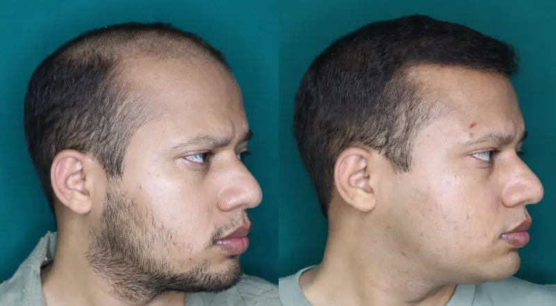 Pt Dharshan Vira hair transplant result 5