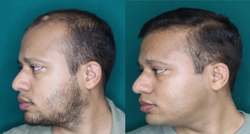 Pt Dharshan Vira hair transplant result 7