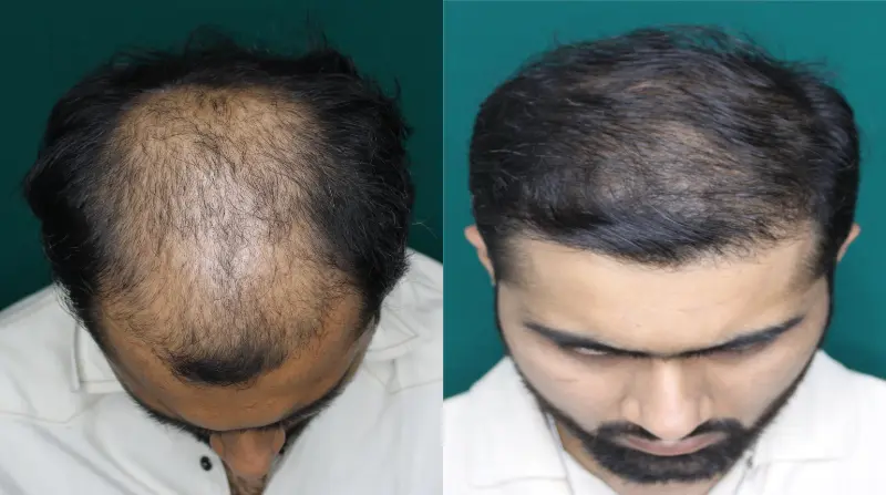 Pt Dherya Nathwani hair transplant result