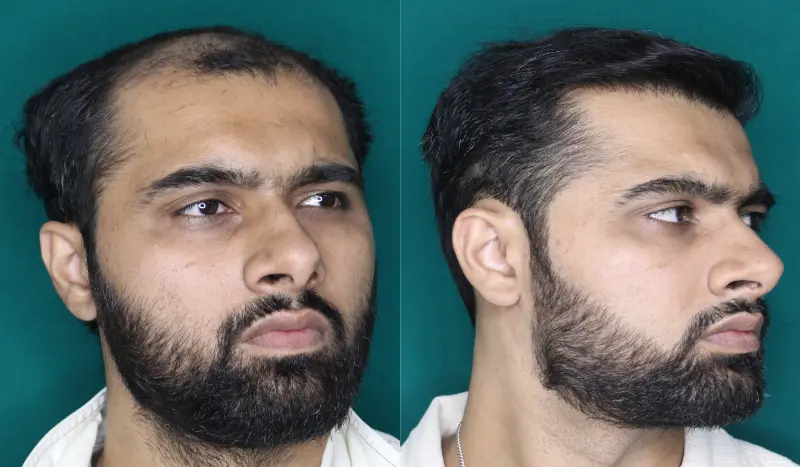 Pt Dherya Nathwani hair transplant result 4