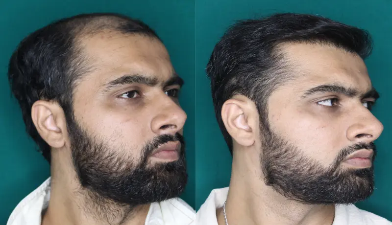Pt Dherya Nathwani hair transplant result 5