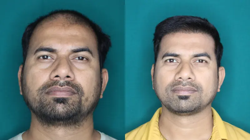 Pt Jagdish Ghar hair transplant result 3