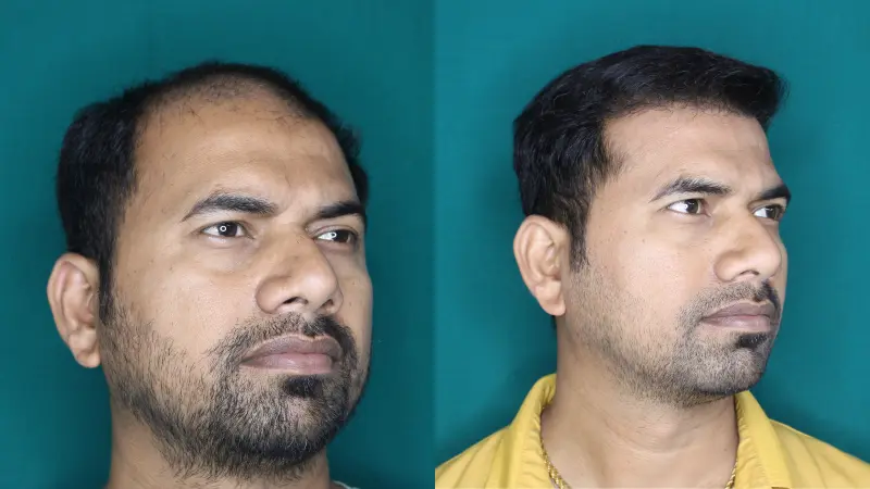 Pt Jagdish Ghar hair transplant result 4
