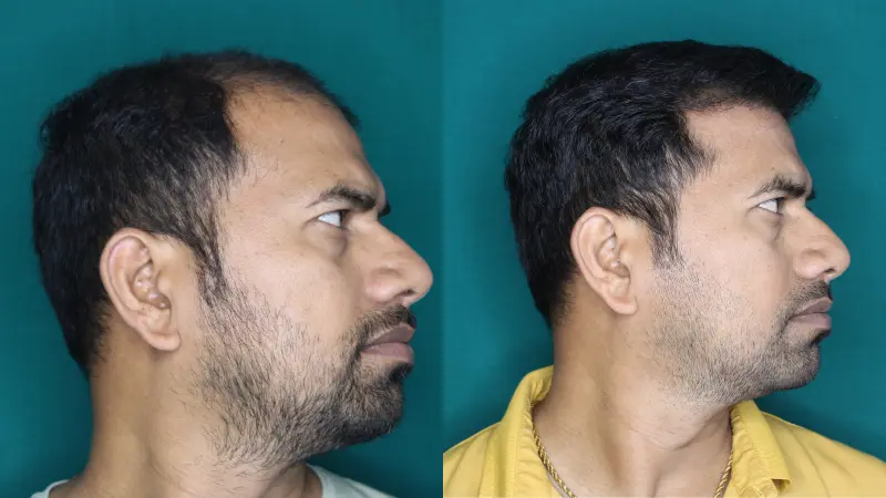 Pt Jagdish Ghar hair transplant result 5