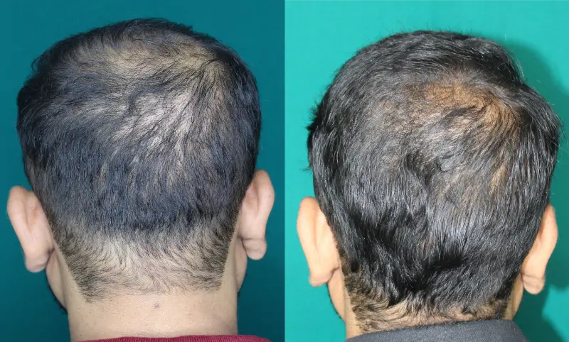 Pt Praful Gole hair transplant result