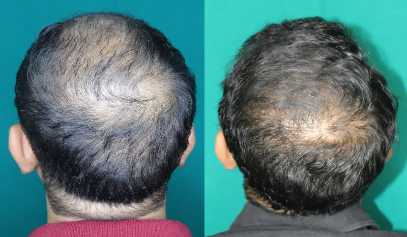 Pt Praful Gole hair transplant result 2