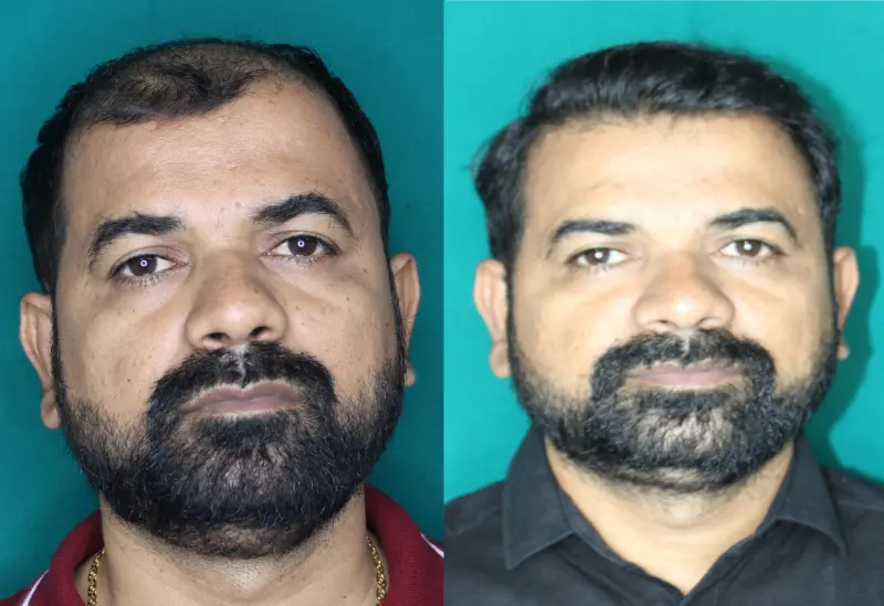 Pt Praful Gole hair transplant result 3