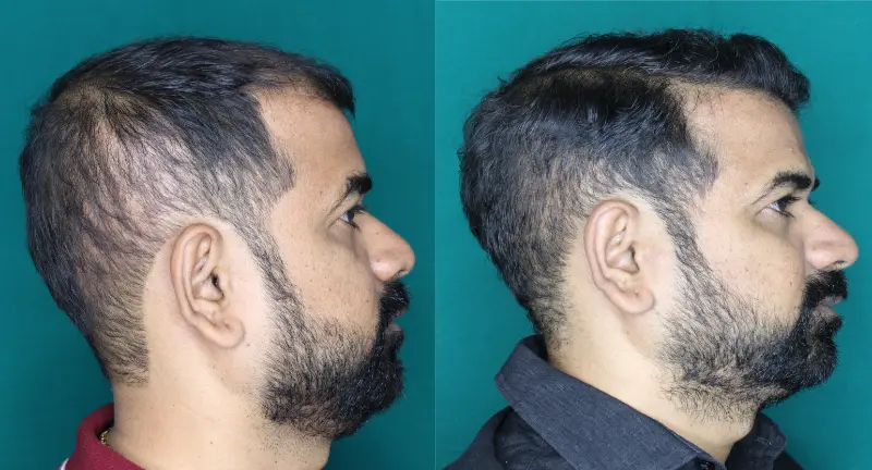 Pt Praful Gole hair transplant result 5