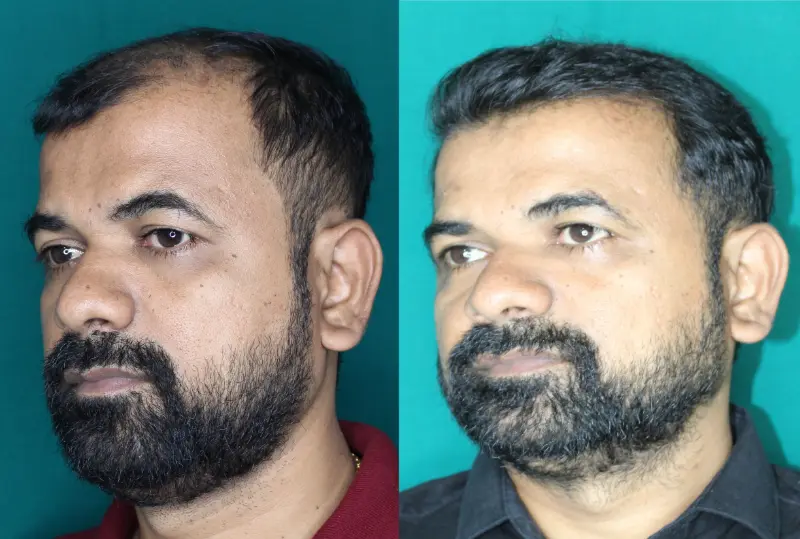 Pt Praful Gole hair transplant result 6