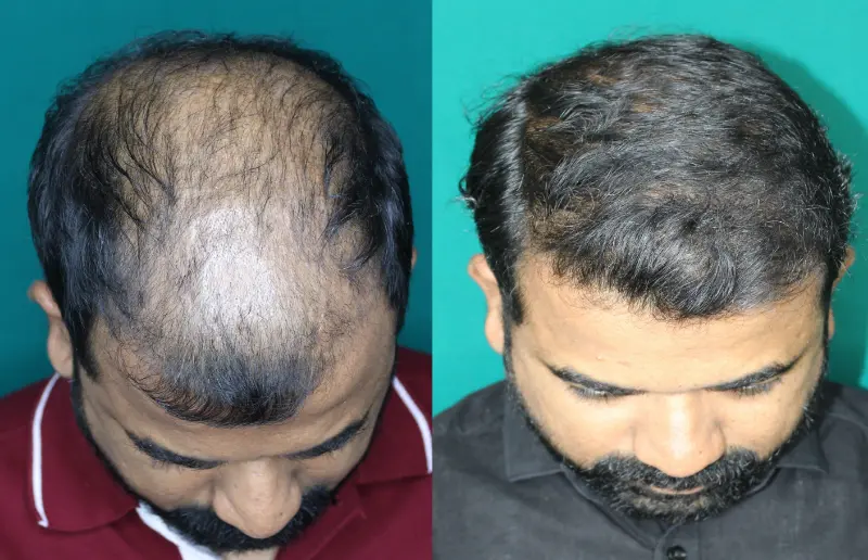 Pt Praful Gole hair transplant result 9