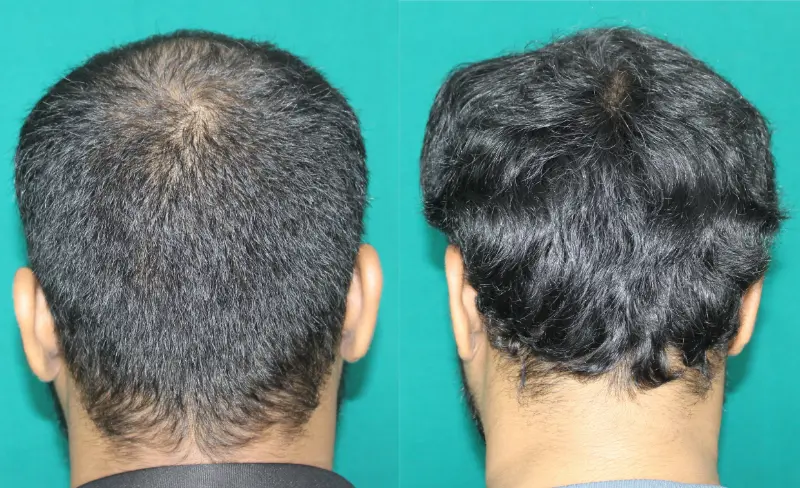 Pt Yohan hair transplant result
