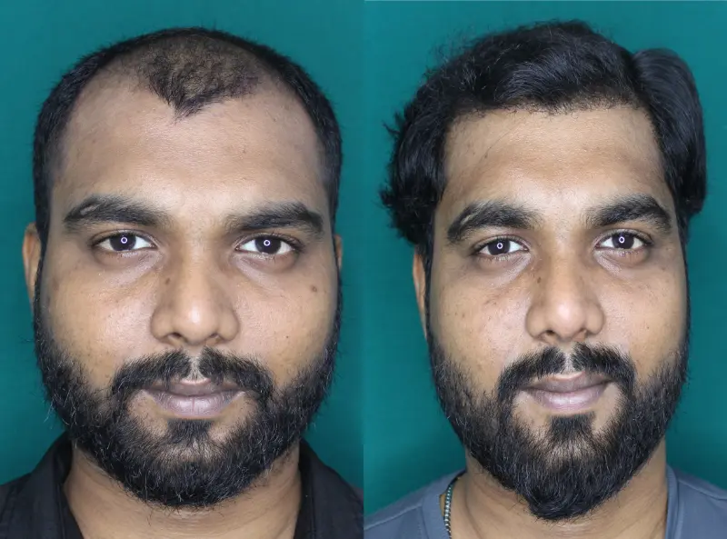 Pt Yohan hair transplant result 3