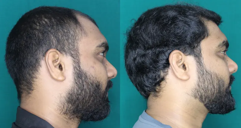 Pt Yohan hair transplant result 5