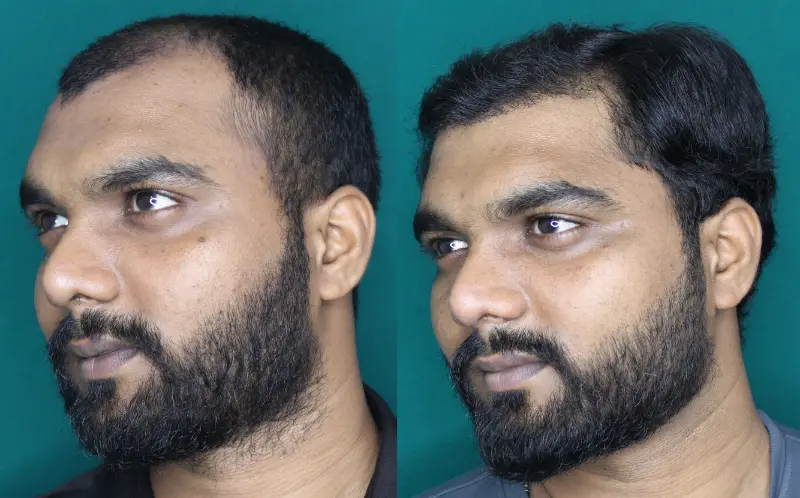Pt Yohan hair transplant result 6