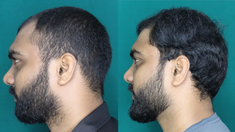 Pt Yohan hair transplant result 7